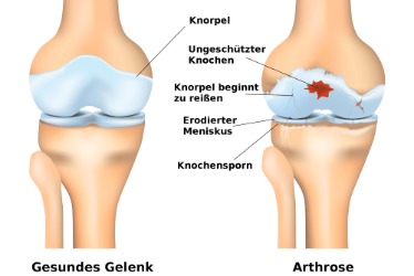 Arthrose im Kniegelenk